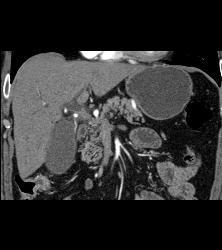 Cholangiocarcinoma With Nodes in Porta - CTisus CT Scan