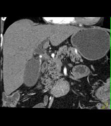 Cholangiocarcinoma With Nodes in Porta - CTisus CT Scan