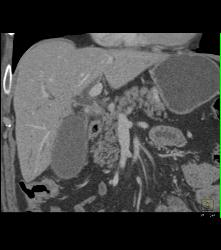 Cholangiocarcinoma With Nodes in Porta - CTisus CT Scan