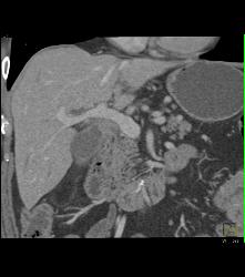 Cholangiocarcinoma With Nodes in Porta - CTisus CT Scan