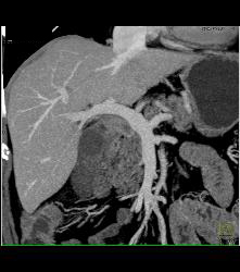 Cholangiocarcinoma With Nodes in Porta - CTisus CT Scan