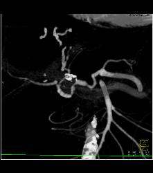 Hepatic Artery Aneurysm in Ehlers-Danlos Syndrome - CTisus CT Scan