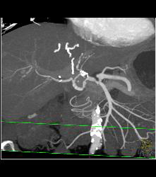 Hepatic Artery Aneurysm in Ehlers-Danlos Syndrome - CTisus CT Scan