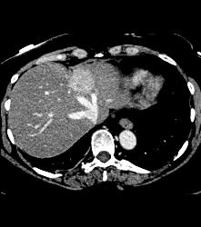 Metastatic Adenocarcinoma - CTisus CT Scan