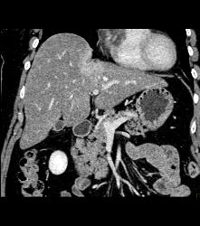 Metastatic Adenocarcinoma - CTisus CT Scan