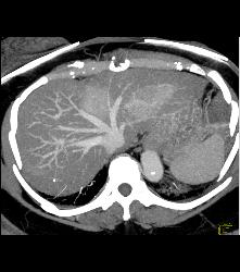 Multifocal Hepatocellular Carcinoma (Hepatoma) (HCC) - CTisus CT Scan