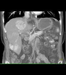 Multifocal Hepatocellular Carcinoma (Hepatoma) (HCC) - CTisus CT Scan