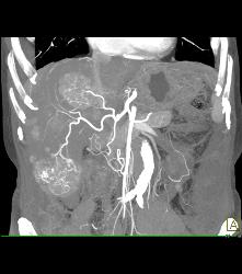 Multifocal Hepatocellular Carcinoma (Hepatoma) (HCC) - CTisus CT Scan