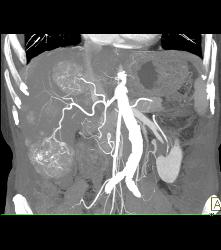 Multifocal Hepatocellular Carcinoma (Hepatoma) (HCC) - CTisus CT Scan