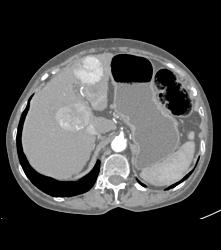 Multifocal Hepatocellular Carcinoma (Hepatoma) (HCC) - Liver Case ...