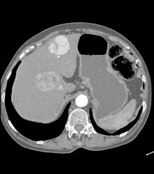 Multifocal Hepatocellular Carcinoma (Hepatoma) (HCC) - CTisus CT Scan