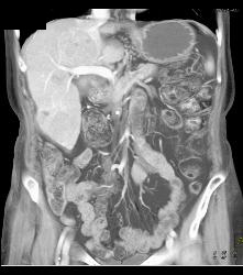 Multifocal Hepatocellular Carcinoma (Hepatoma) (HCC) - CTisus CT Scan