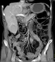 Multifocal Hepatocellular Carcinoma (Hepatoma) (HCC) - CTisus CT Scan