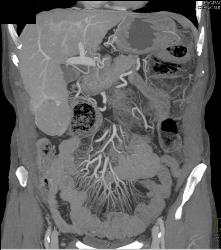 Multifocal Hepatocellular Carcinoma (Hepatoma) (HCC) - CTisus CT Scan