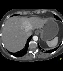 Focal Nodular Hyperplasia (FNH) - CTisus CT Scan