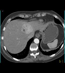 Focal Nodular Hyperplasia (FNH) - CTisus CT Scan