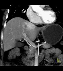 Focal Nodular Hyperplasia (FNH) - CTisus CT Scan