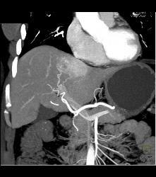 Focal Nodular Hyperplasia (FNH) - CTisus CT Scan