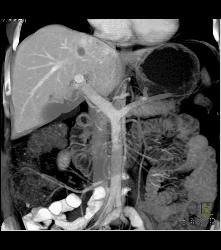 Focal Nodular Hyperplasia (FNH) - CTisus CT Scan