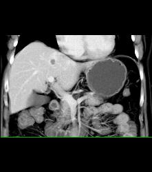 Focal Nodular Hyperplasia (FNH) - CTisus CT Scan