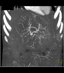 Leiomyosarcoma of the Liver - CTisus CT Scan