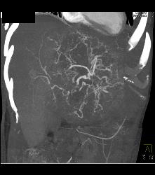 Leiomyosarcoma of the Liver - CTisus CT Scan