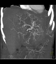 Leiomyosarcoma of the Liver - CTisus CT Scan