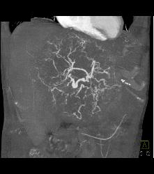 Leiomyosarcoma of the Liver - CTisus CT Scan