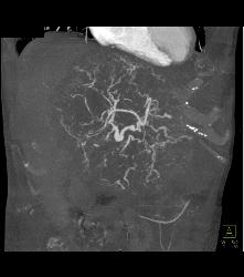 Leiomyosarcoma of the Liver - CTisus CT Scan