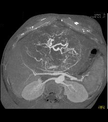 Leiomyosarcoma of the Liver - CTisus CT Scan