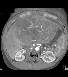 Leiomyosarcoma of the Liver - CTisus CT Scan