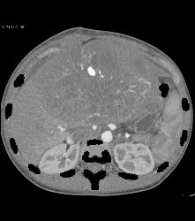 Leiomyosarcoma of the Liver - CTisus CT Scan