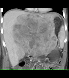 Leiomyosarcoma of the Liver - CTisus CT Scan