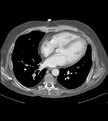 Liver Infarct and Abscess S/p Hepatic Artery Occlusion Post Transplant - CTisus CT Scan