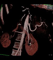 Liver Infarct and Abscess S/p Hepatic Artery Occlusion Post Transplant - CTisus CT Scan