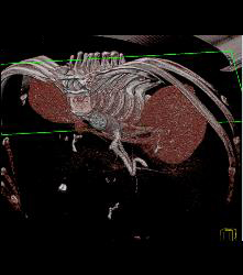 Liver Infarct and Abscess S/p Hepatic Artery Occlusion Post Transplant - CTisus CT Scan