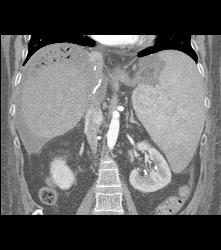 Liver Infarct and Abscess S/p Hepatic Artery Occlusion Post Transplant - CTisus CT Scan