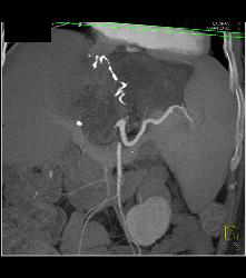 Liver Infarct and Abscess S/p Hepatic Artery Occlusion Post Transplant - CTisus CT Scan