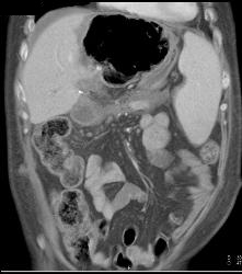 Liver Infarct and Abscess S/p Hepatic Artery Occlusion Post Transplant - CTisus CT Scan