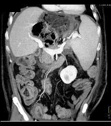 Liver Infarct and Abscess S/p Hepatic Artery Occlusion Post Transplant - CTisus CT Scan