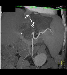 Liver Infarct and Abscess S/p Hepatic Artery Occlusion Post Transplant - CTisus CT Scan