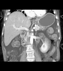 Hemangioma - CTisus CT Scan