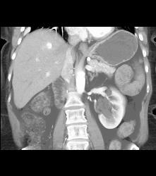 Hemangioma - CTisus CT Scan