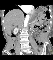 Flow Changes Liver on Venous Phase. Not Sure of Etiology - CTisus CT Scan