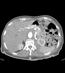 Flow Changes Liver on Venous Phase. Not Sure of Etiology - CTisus CT Scan