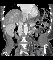 Flow Changes Liver on Venous Phase. Not Sure of Etiology - CTisus CT Scan