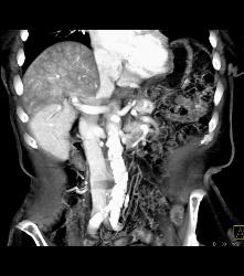 Flow Changes Liver on Venous Phase. Not Sure of Etiology - CTisus CT Scan