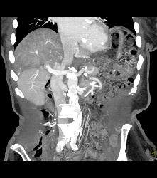 Flow Changes Liver on Venous Phase. Not Sure of Etiology - CTisus CT Scan