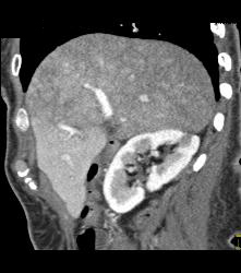 Flow Changes Liver on Venous Phase. Not Sure of Etiology - CTisus CT Scan