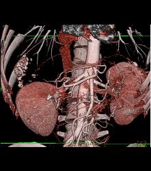 Displaced Hepatic Artery - CTisus CT Scan